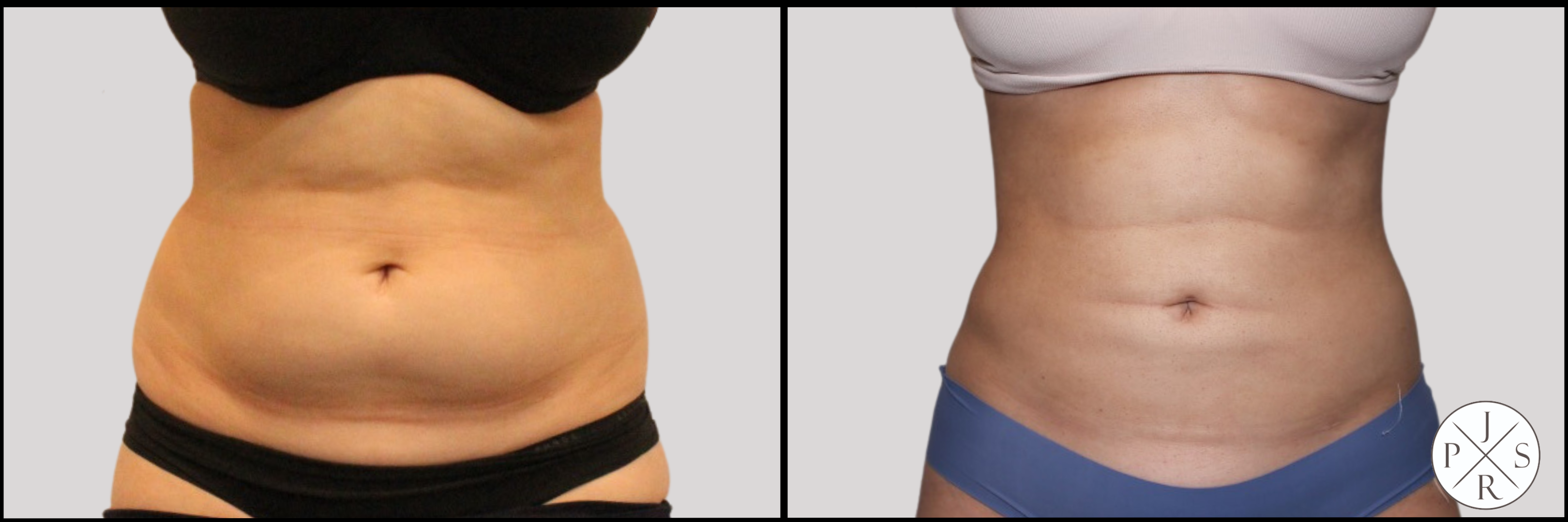 Liposuction Before & After Image